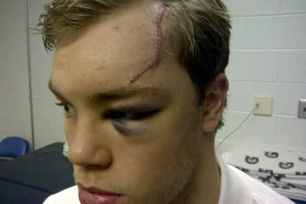 Disgusting Injury Pics Athletes Post on Twitter