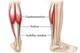 The Achilles tendon connects the muscle bodies of the gastrocnemius and soleus to the back of the heel. When it contracts, it pulls on the back of the heel, resulting in plantarflexion. Photo courtesy of WebMD.com.