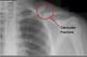 This X-ray shows a displaced clavicle fracture.