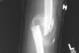 The haziness surrounding this severe arm fracture depicts a forming callus.