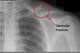 This X-ray shows a displaced clavicle (collarbone) fracture.