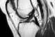 MRIs allow doctors to closely inspect soft tissues such as ligaments and tendons. In this knee MRI, the anterior cruciate ligament (ACL) and posterior cruciate ligament (PCL) are marked by the left and right arrows, respectively.