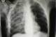 This X-ray shows findings—white haziness on the left side, the patient's right lung—that may represent a pulmonary contusion. On the left side (the patient's right lung).