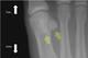 This X-ray shows the location of the two sesamoid bones—highlighted by yellow arrows—under the base of the big toe.