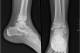 A high-ankle sprain injures the ligaments that connect the long bones of the lower leg—the tibia and fibula, seen above coming from the top of the X-ray—to each other.