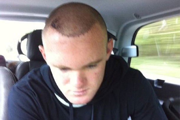 How Wayne Rooney's Hair Transplant Changed Football History | News, Scores,  Highlights, Stats, and Rumors | Bleacher Report