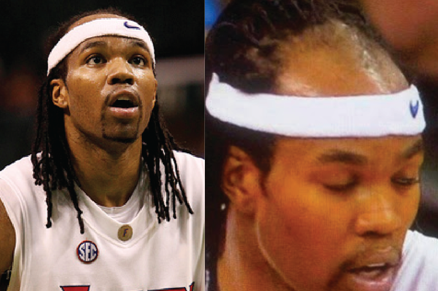 Athletes Who Can't Hide Their Baldness Bleacher Report Athletes Who Can't Hide Their Baldness Bleacher Report