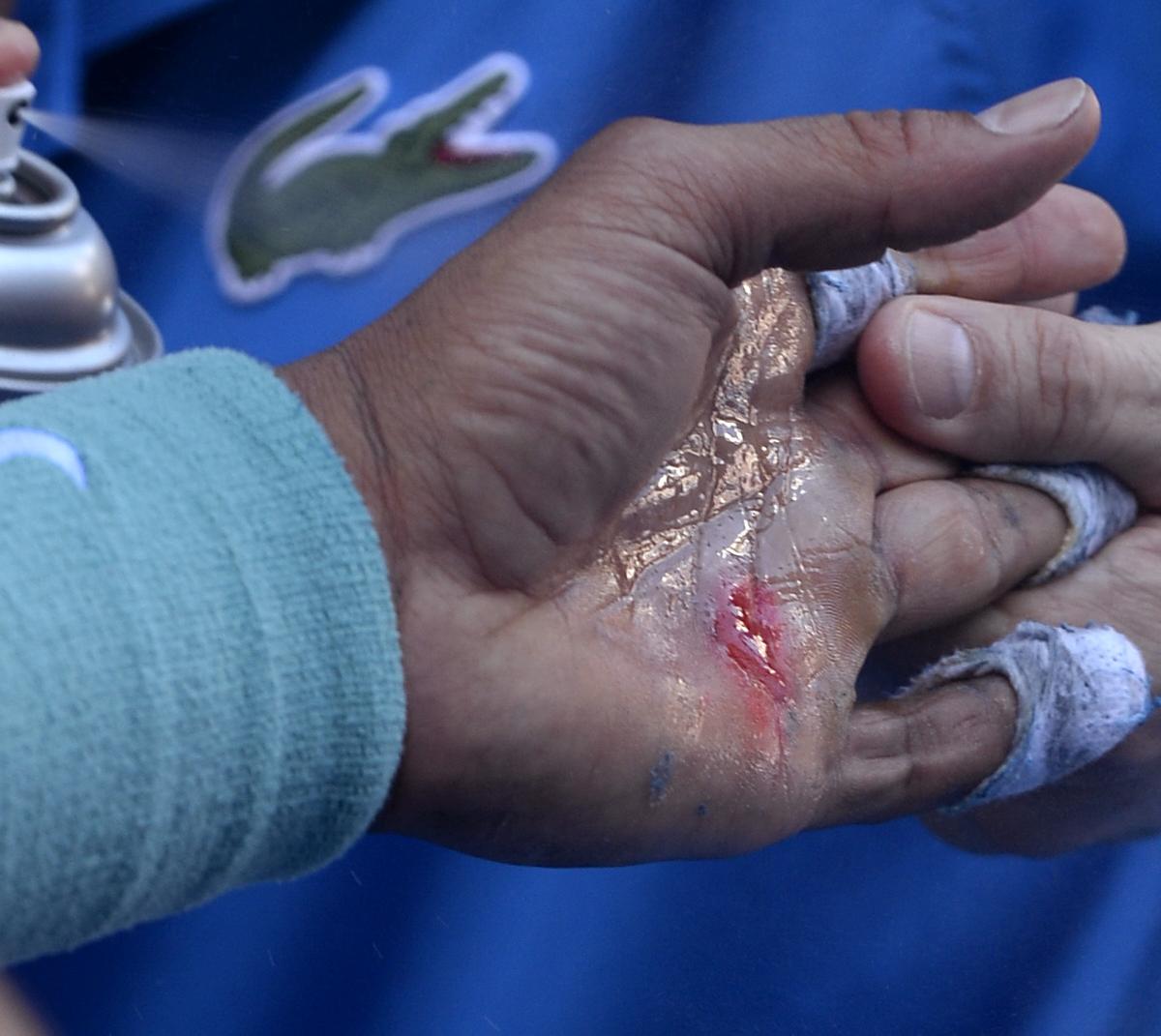 Rafael Nadal S Blistered Hand At Australian Open Match Looks Painful Bleacher Report Latest News Videos And Highlights
