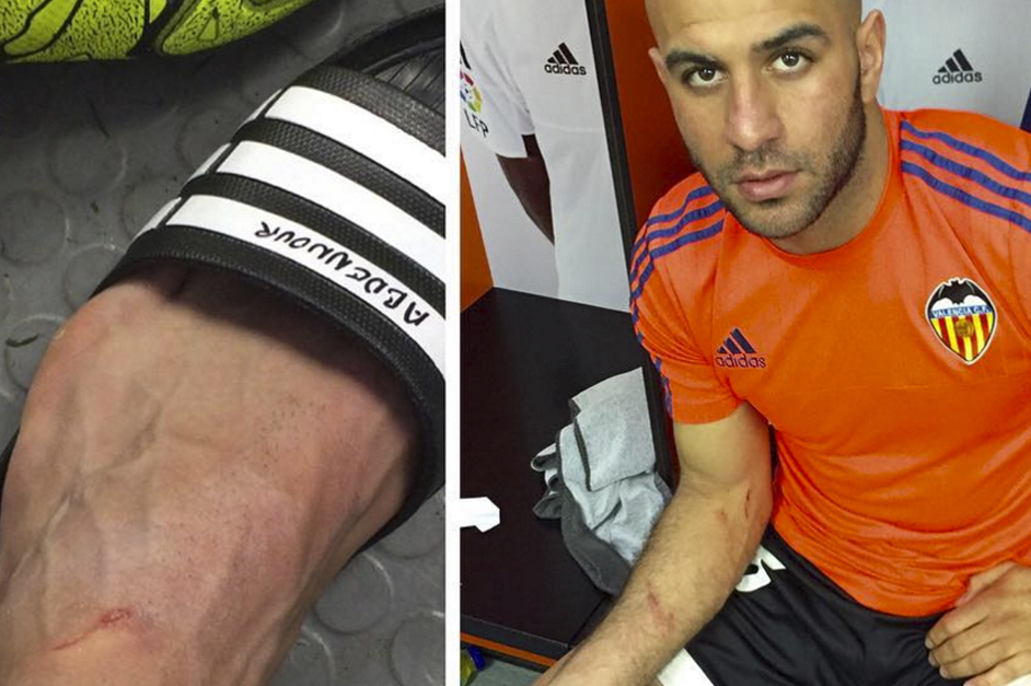 Aymen Abdennour Shares Images Of Scars On Instagram After Clash With Suarez Bleacher Report Latest News Videos And Highlights